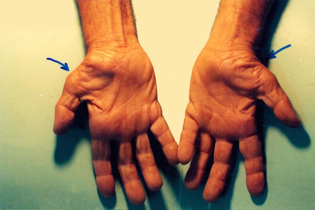 Untreated_Carpal_Tunnel_Syndrome
